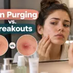 skin-purging-vs-breakouts